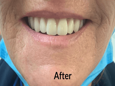 After denture treatment smile transformation case four