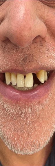 Before denture treatment smile transformation case five