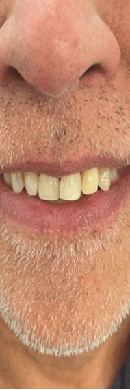 After denture treatment smile transformation case five