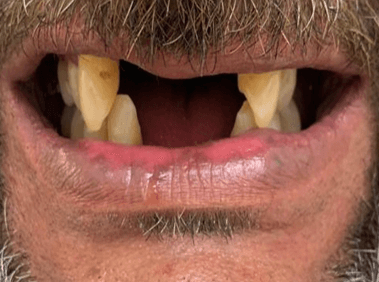 Before denture treatment smile transformation case six