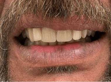 After denture treatment smile transformation case six