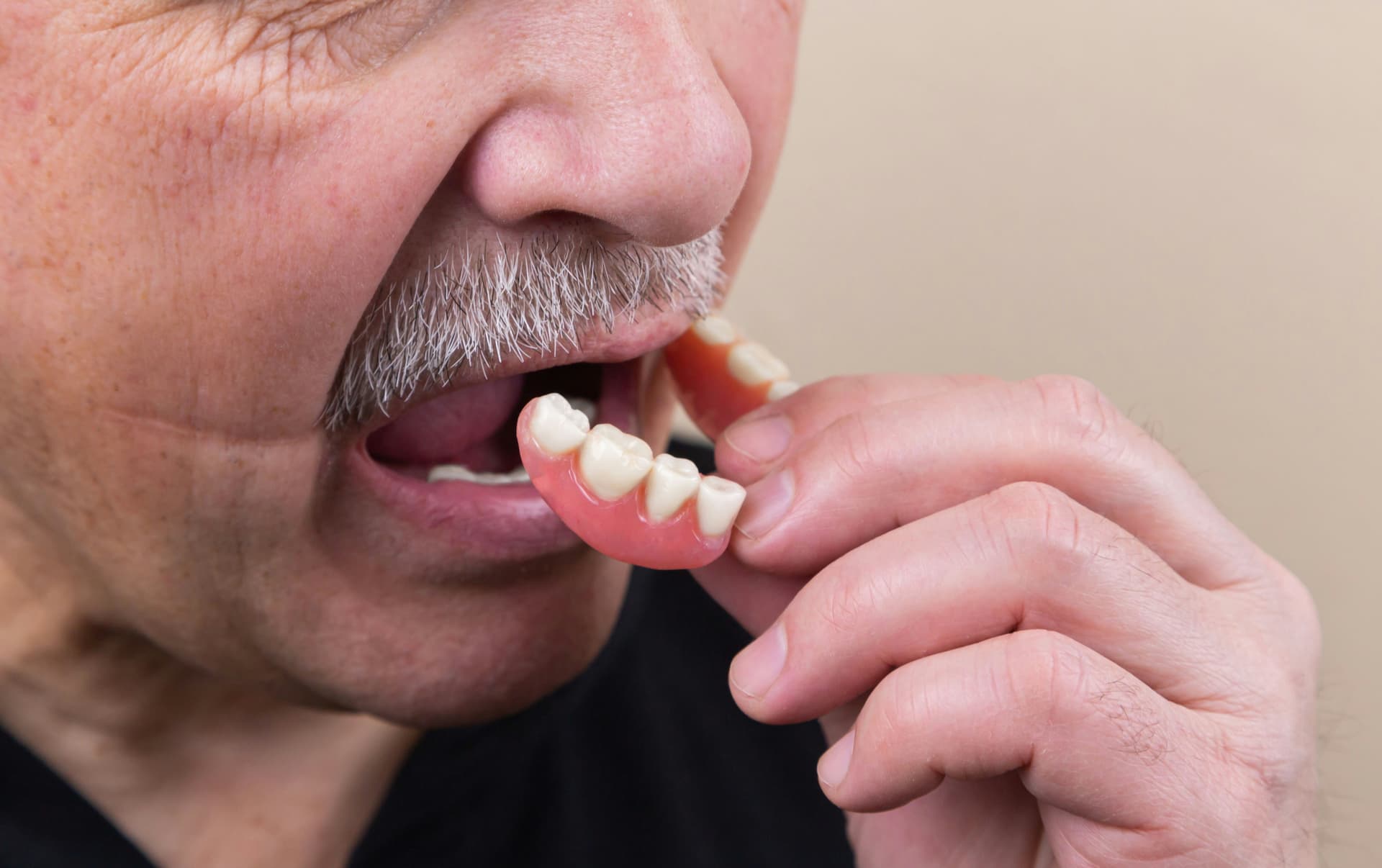 Immediate Dentures denture service