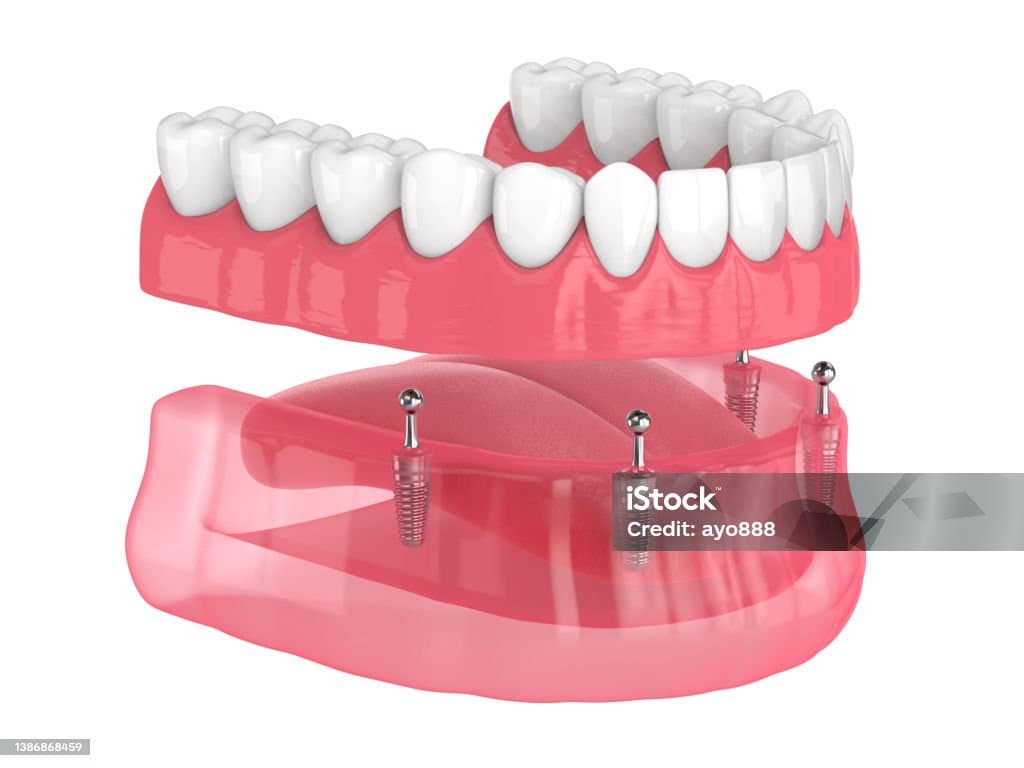 Implant Over-Dentures denture service